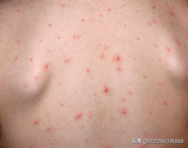 幼儿发热怎么处理视频,幼儿发热肚子疼是什么原因