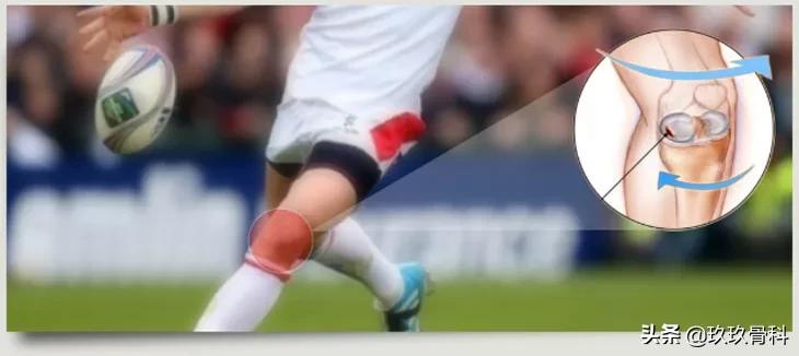 半月板损伤是否需要手术,外侧半月板损伤手术费用