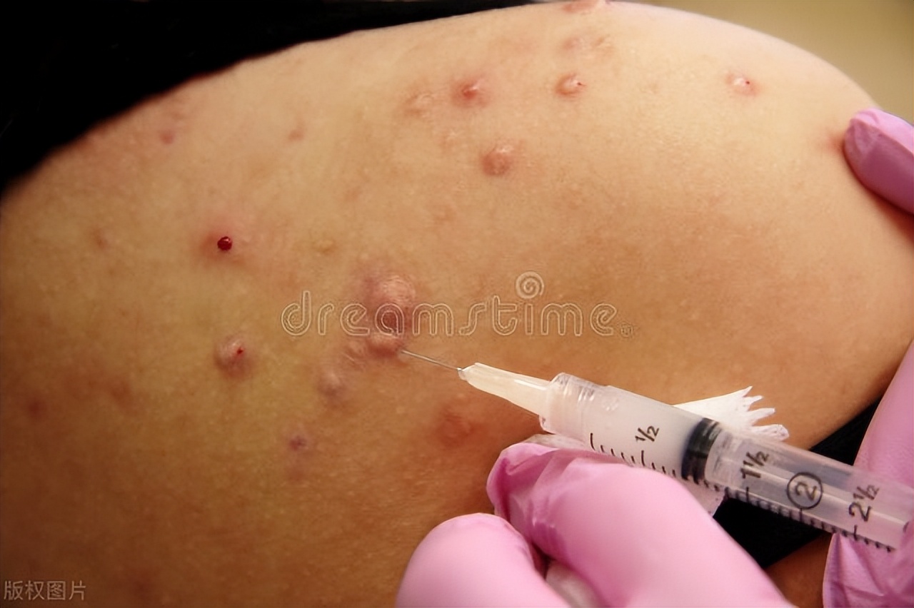 女士怎么确诊得了淋病,女生去医院检查有没有得淋病