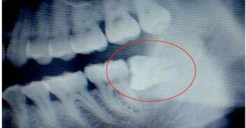自从长了智齿，总是咬到腮帮子怎么办？专家：建议拔除