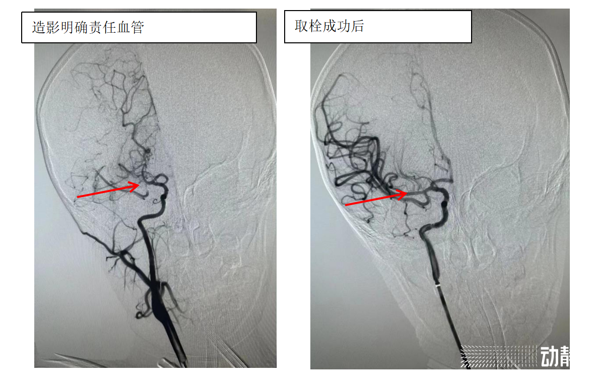 儿童脑卒中治疗,脑卒中患者多科室协作救治