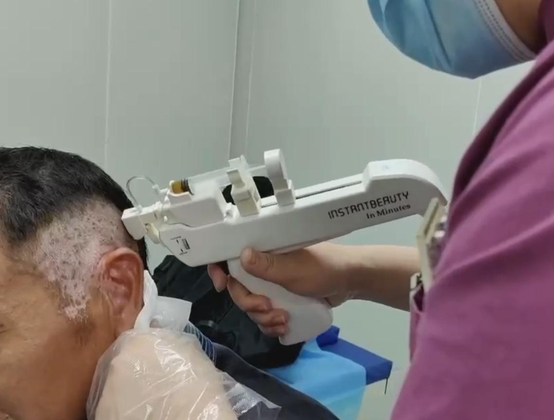 无针疗法让40多岁头部白斑患者重见希望