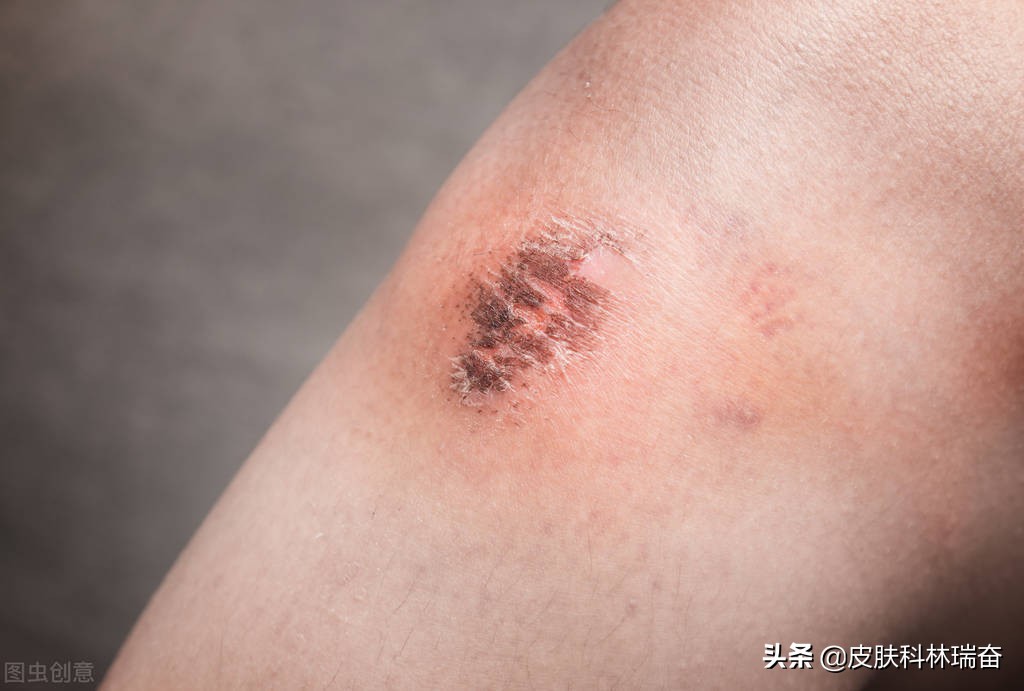 儿童一毫米深的凹陷疤痕怎么处理,各种疤的修复方法