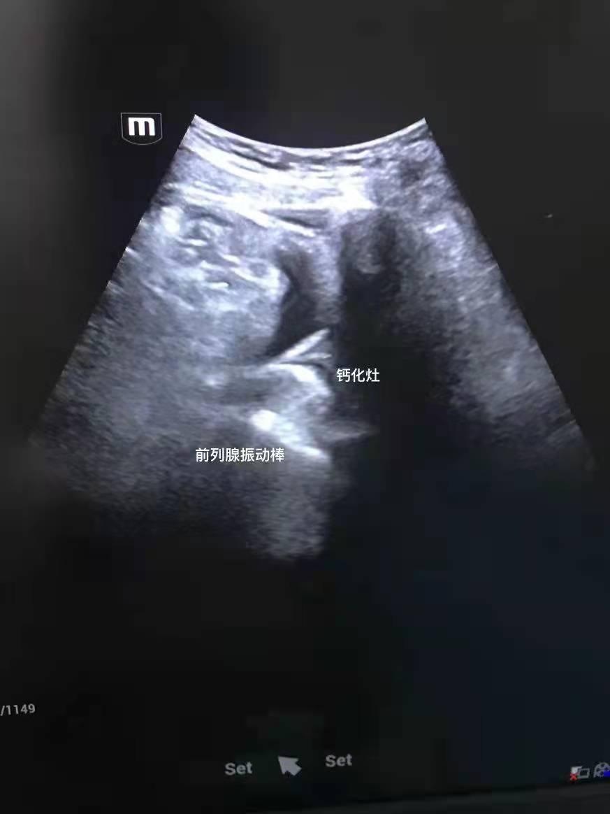 男人前列腺钙化怎么回事,前列腺钙化对男人有什么影响