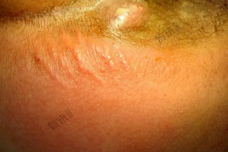 肛周脓肿炎症引起的发烧症状,肛周脓肿病人的体格检查