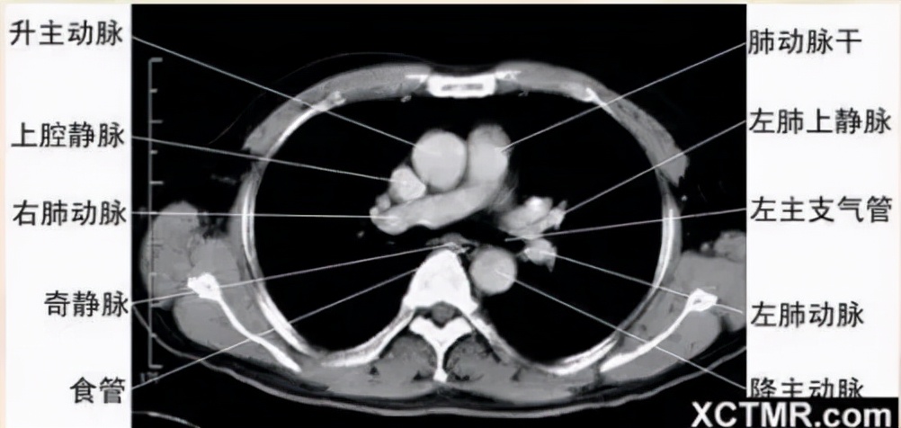 胸腹部盆腔ct主要检查什么,女性盆腔ct断层解剖结构图