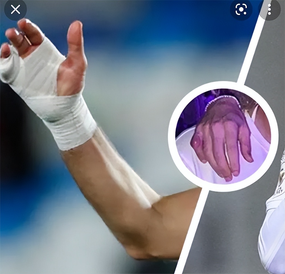 本泽马的右手金色绷带,本泽马绷带打手腕