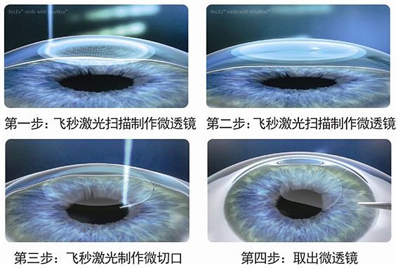全飞秒手术和戴最轻眼镜如何选择,做完全飞秒的眼睛跟正常眼对比