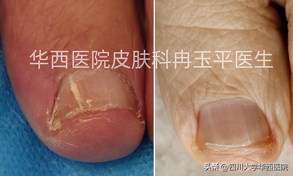 得了灰指甲是指甲变灰吗,灰指甲增厚变黑是灰指甲吗