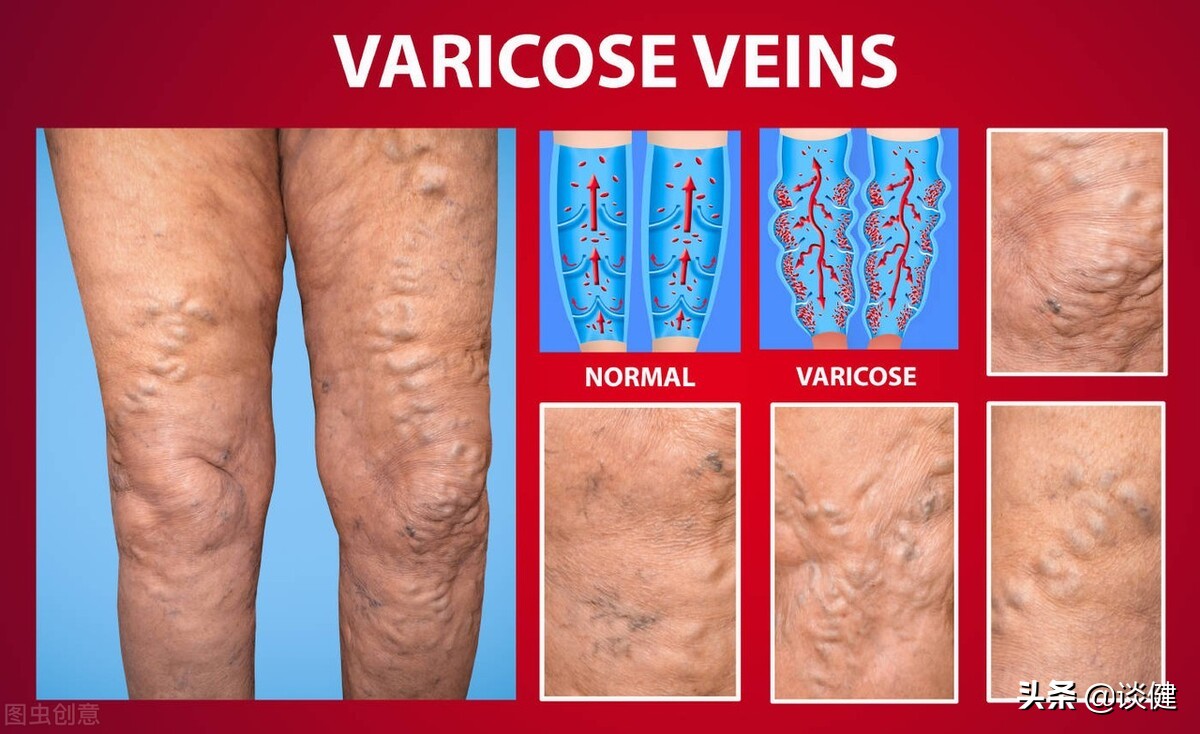 走久了下肢无力怎么回事,走多了脚好痛怎么治