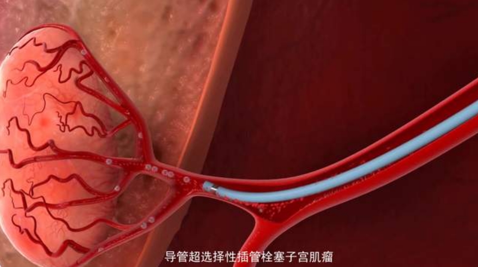 介入治疗子宫肌瘤的弊端,子宫肌瘤微创介入治疗属几级手术