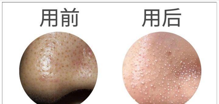 鼻子上有白白的小点可以挤吗,鼻子上黑黑的小点点怎么去除