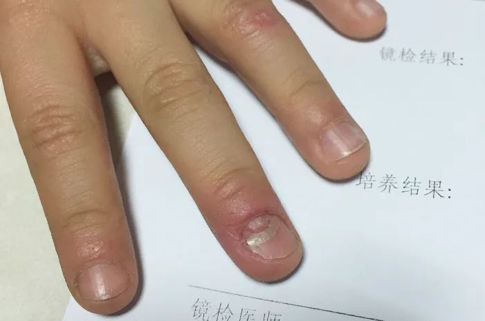 3岁男宝宝手指甲根部开始脱落,三岁小孩手指甲脱落怎么回事