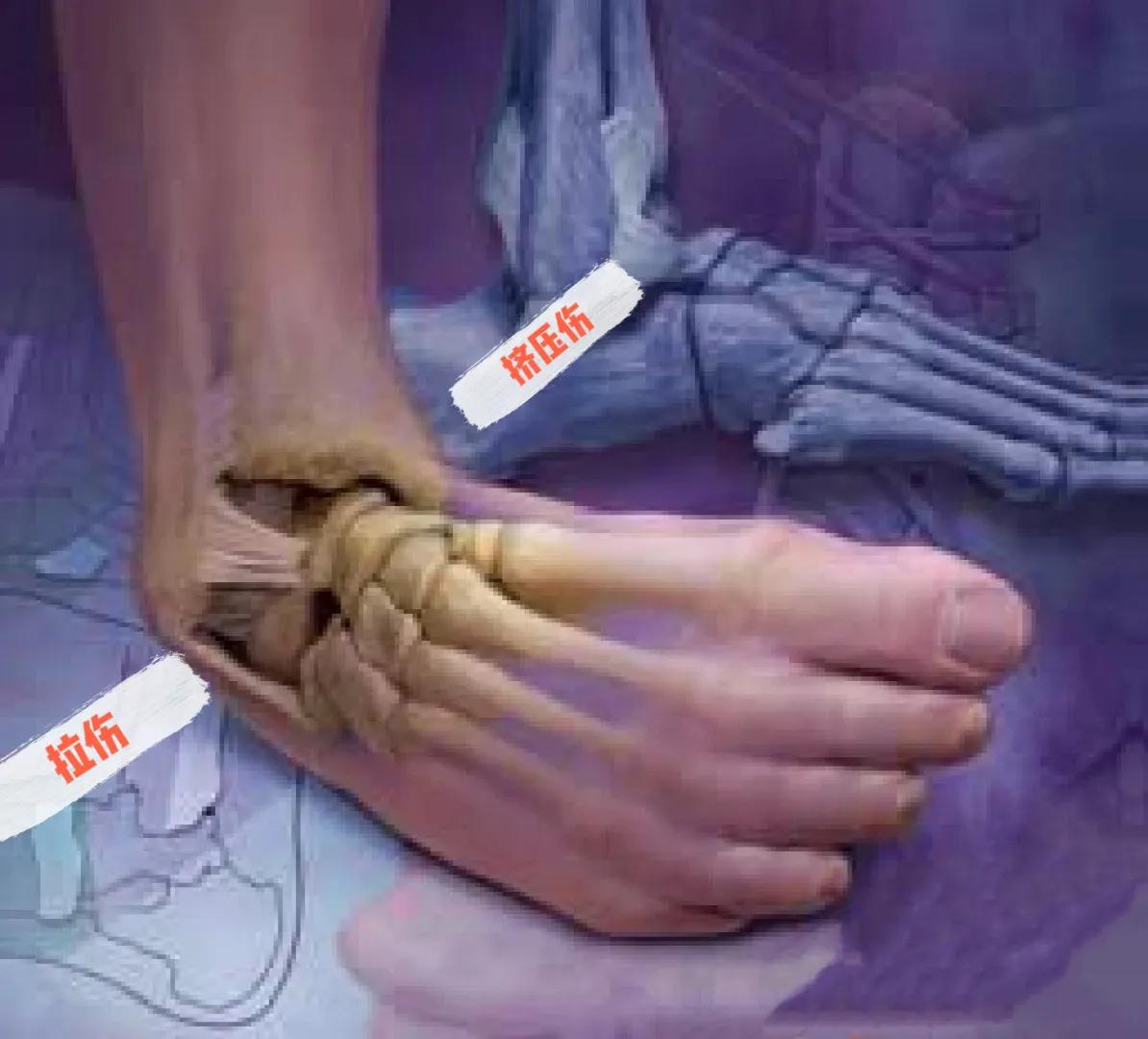 崴脚怎么知道复位了,崴脚别慌4招教你快速康复