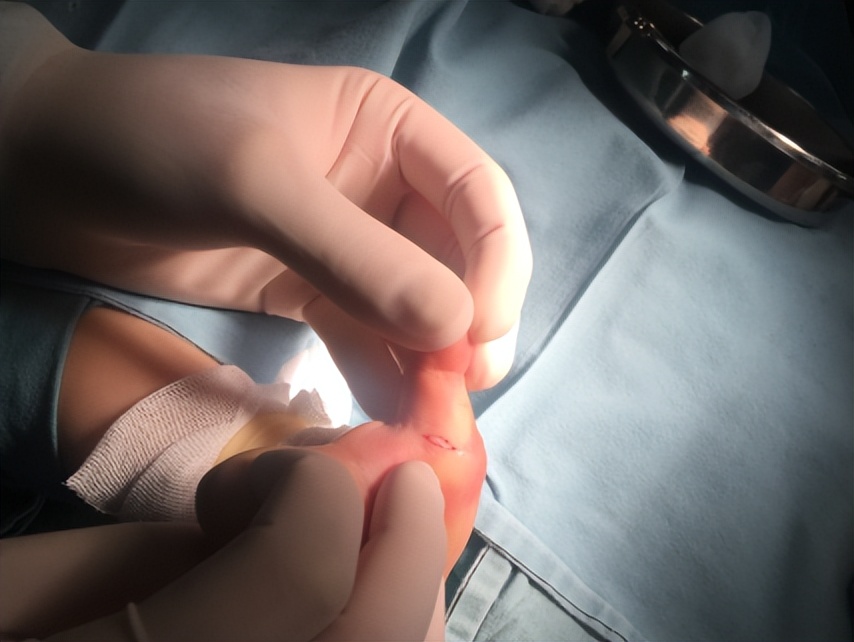 宝宝手长怎么办,宝宝手指长硬皮怎么回事