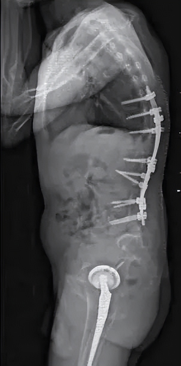 手术后平躺六小时睡着了,手术后终于睡着了