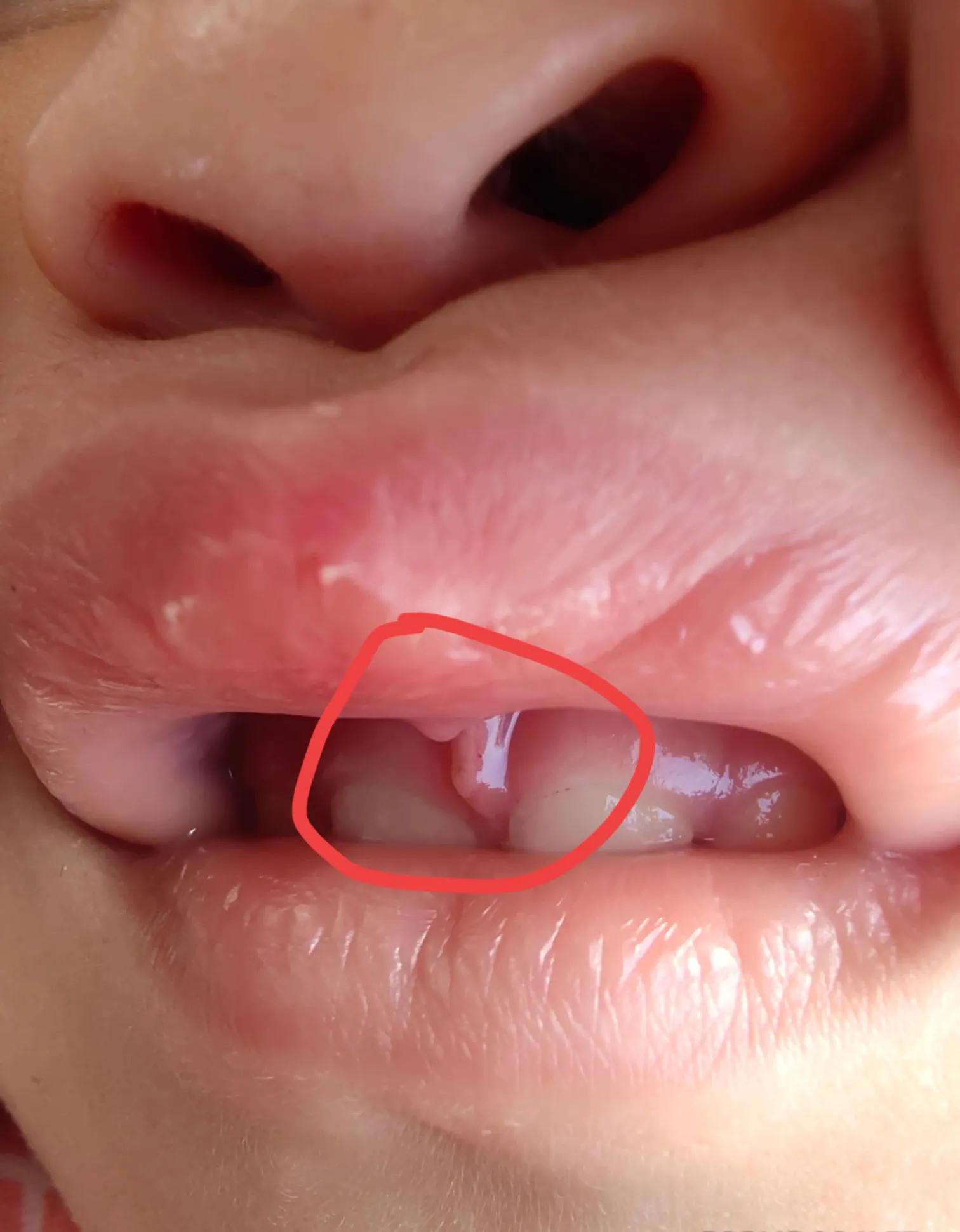 宝宝学走路，把上唇系带线磕断裂，爸爸吓坏了，坚持要去医院检查