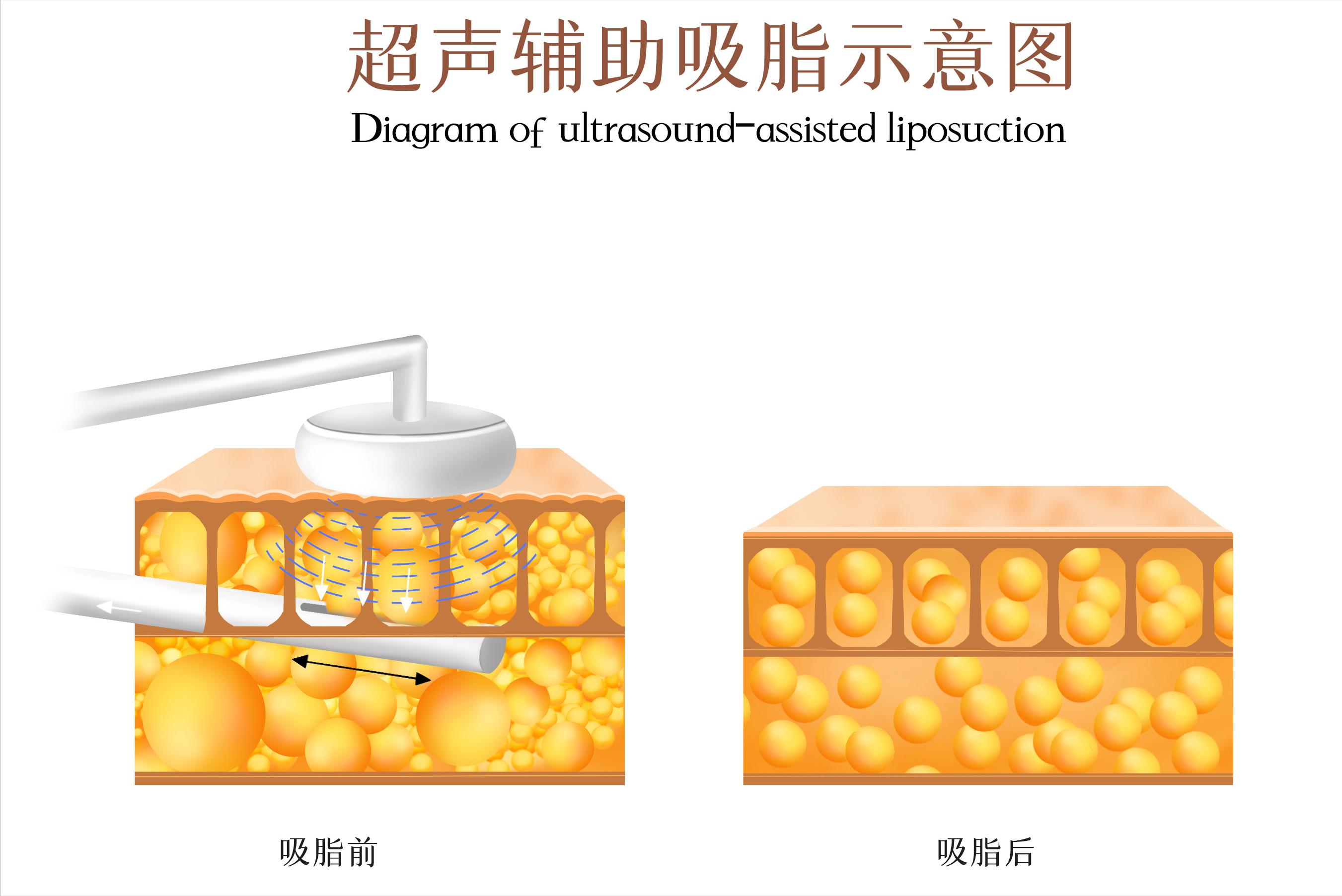 吸脂手术的四大误区,吸脂一般吸哪几个部位