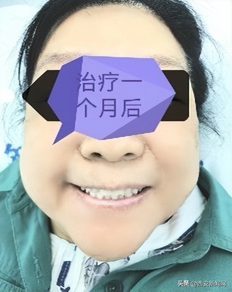 面瘫治疗三个月患侧脸变小了,重度面瘫恢复的征兆