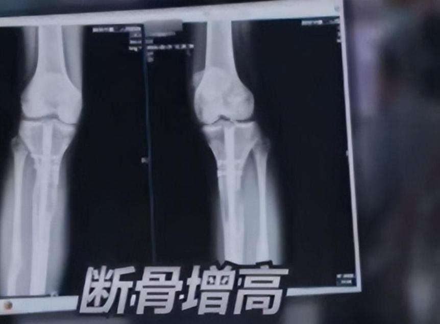 李亚诺中国断骨增高第一人,当年花16万断腿增高