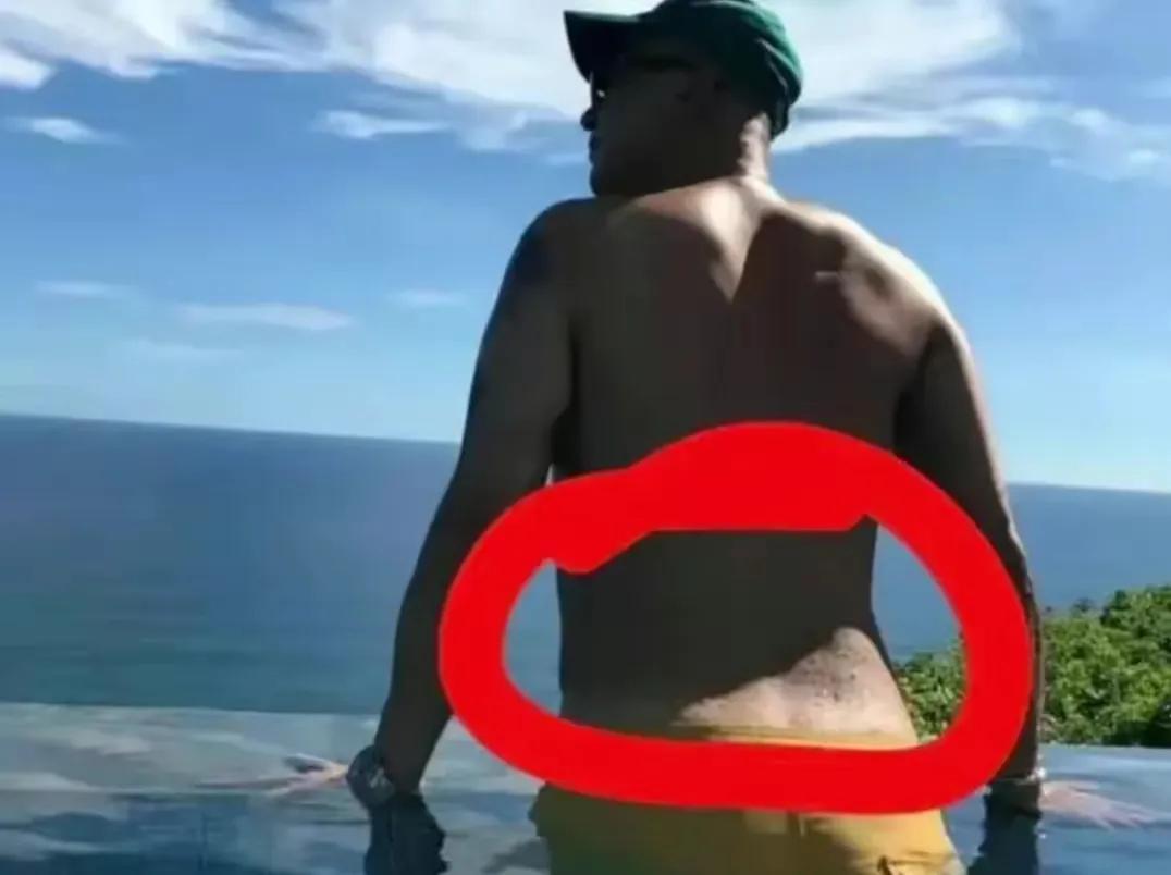 皮肤科董医生:“卤蛋哥”后腰长的真是湿疣?