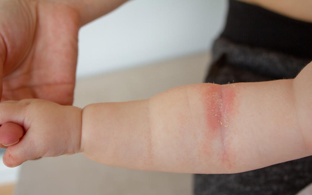 仓鼠咬人全身皮肤变成火龙果事件,杭州一女子买仓鼠得恙虫病