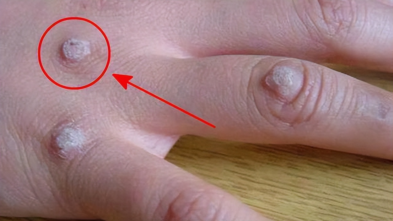 皮肤长“小肉球”是怎么回事，可以抠掉吗？该如何去除？望知晓