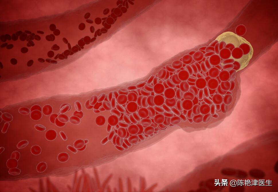 55岁大叔斑块消失，他长期坚持3个“护血管”方法，行之有效