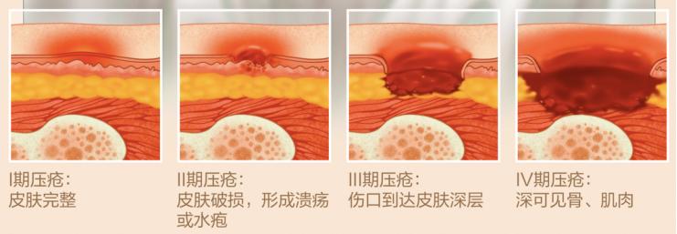 什么叫压疮压疮分几期怎样预防,严重压疮怎么快速愈合