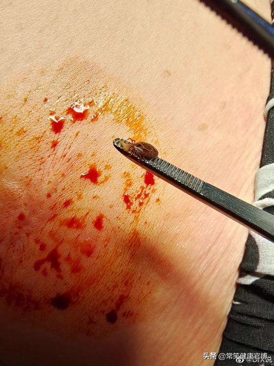 又到高发季外出警惕这种夺命虫,警惕这些“夺命虫”