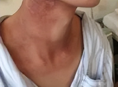 放疗皮肤护理健康宣教,放疗患者皮肤反应分类和护理