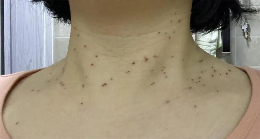 脖子上长很多丝状小肉球怎么办？医生：教你根除丝状疣和皮赘方法