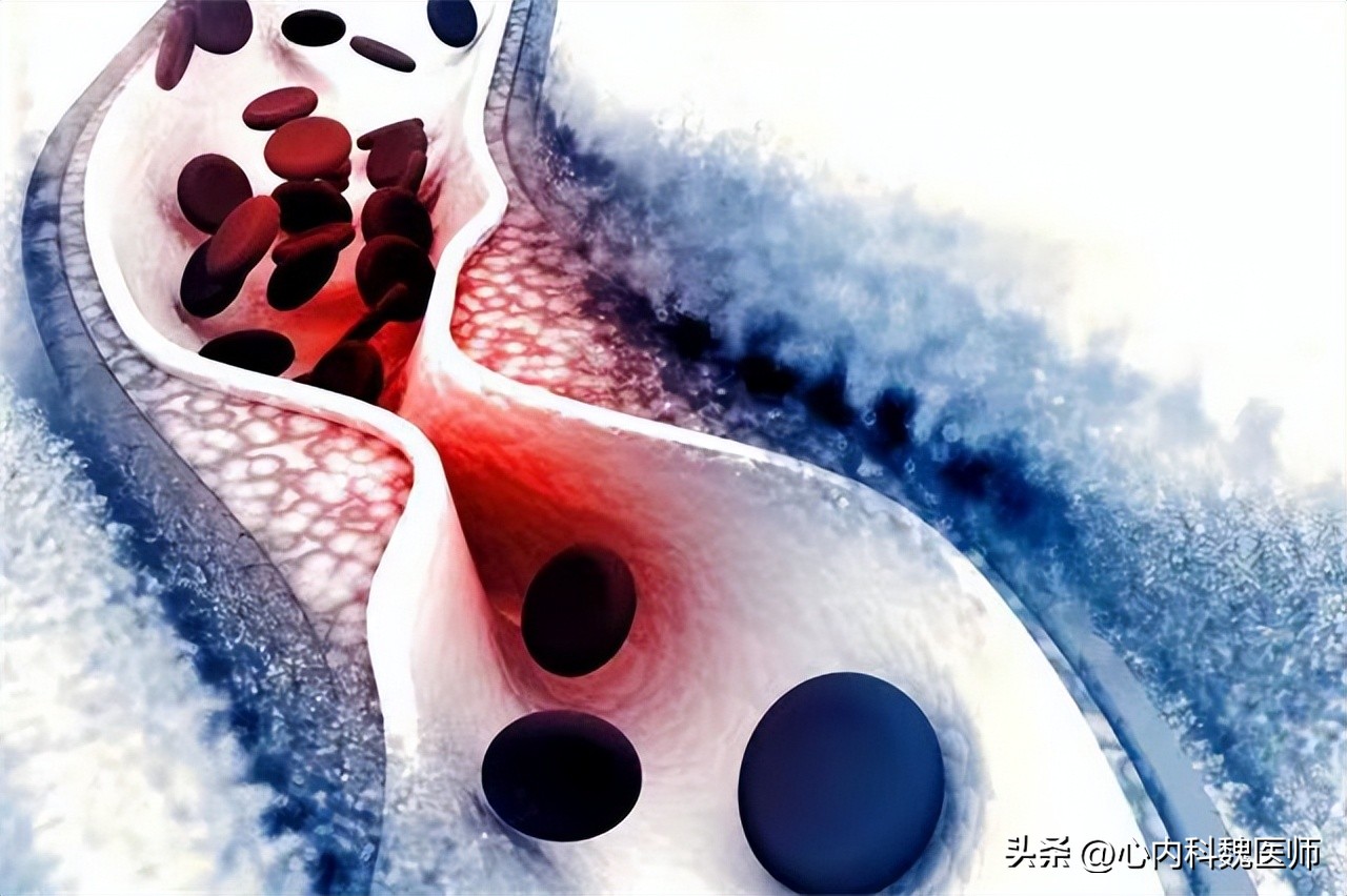 两种降压新药可保护心肾,心脑血管疾病用哪种降压药好