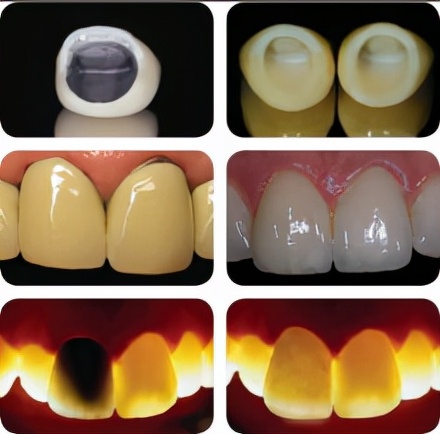 烤瓷牙的缺点危害亲身经历,烤瓷牙各有哪些优缺点