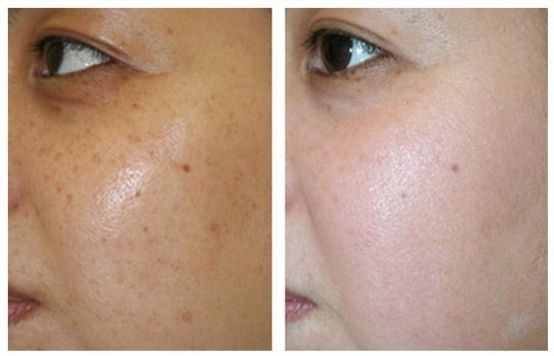 皮肤暗黄怎么去黄效果最好,皮肤暗黄怎么快速消除