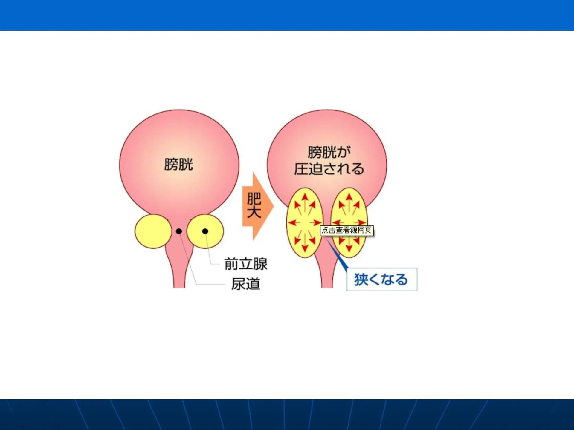 慢性前列腺炎患者应注意哪些问题,了解前列腺炎的食疗及如何预防