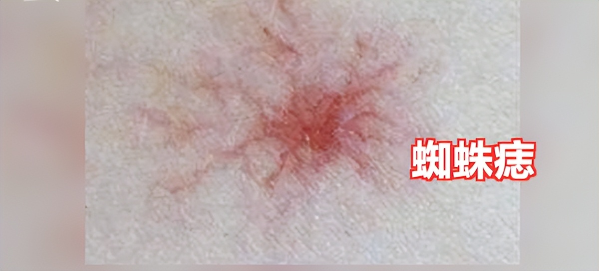 一旦身上出现这2种痣，多半是被癌盯上了！其中一种是肝癌的信号，别因为不痛不痒忽略了