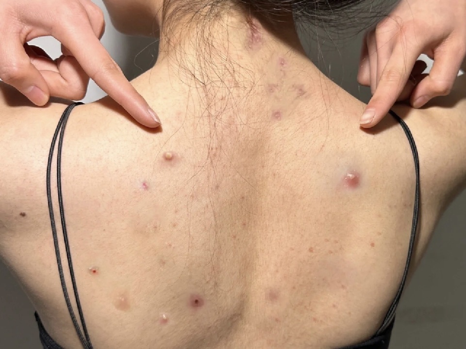 祛痘沐浴露泡泡,祛痘沐浴露除螨