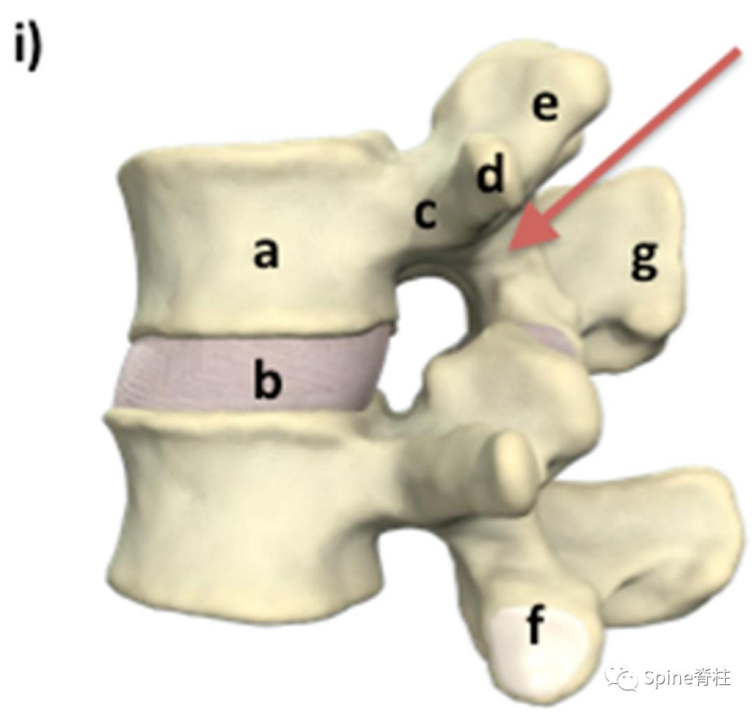 轻度峡部裂和重度峡部裂的区别,真性峡部裂和假性峡部裂