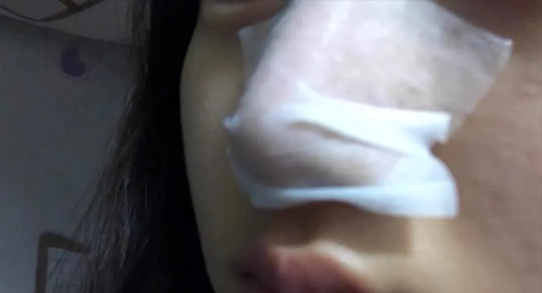 鼻子黑头里挤出的白色油脂怎么办,鼻子上有硬硬的黑头怎么办