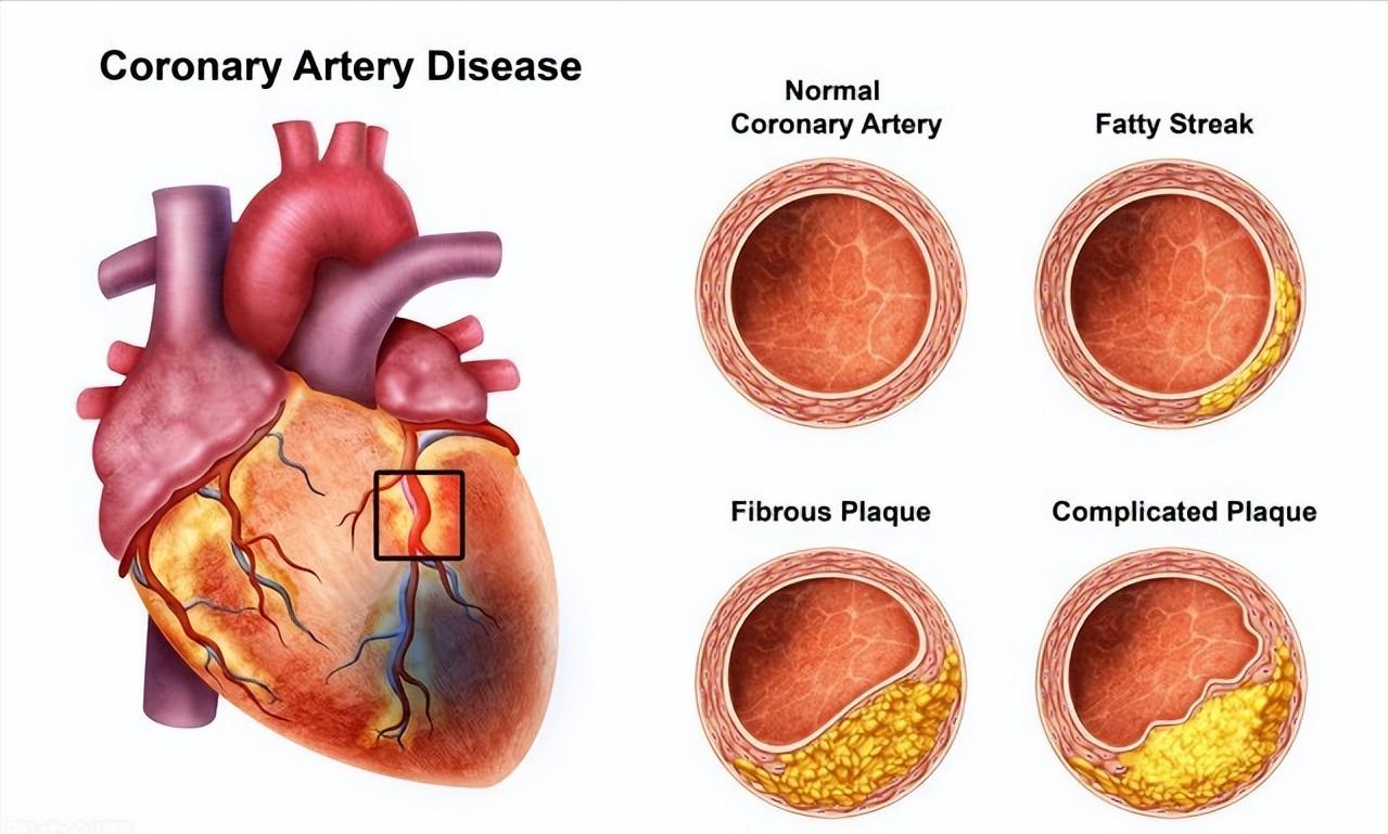 强心降脂抗动脉粥样硬化,冠心病治疗一线降脂药物