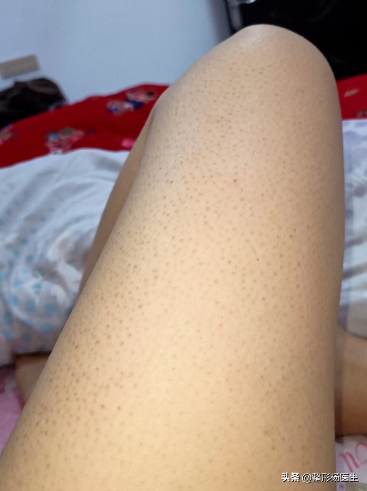 做吸脂是种什么体验,揭秘吸脂全过程