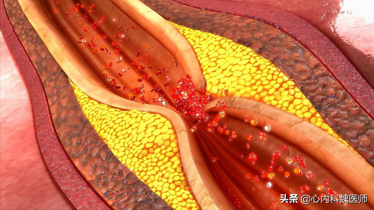 心肌缺血吃什么药效果更好,心肌缺血吃什么药效果比较好