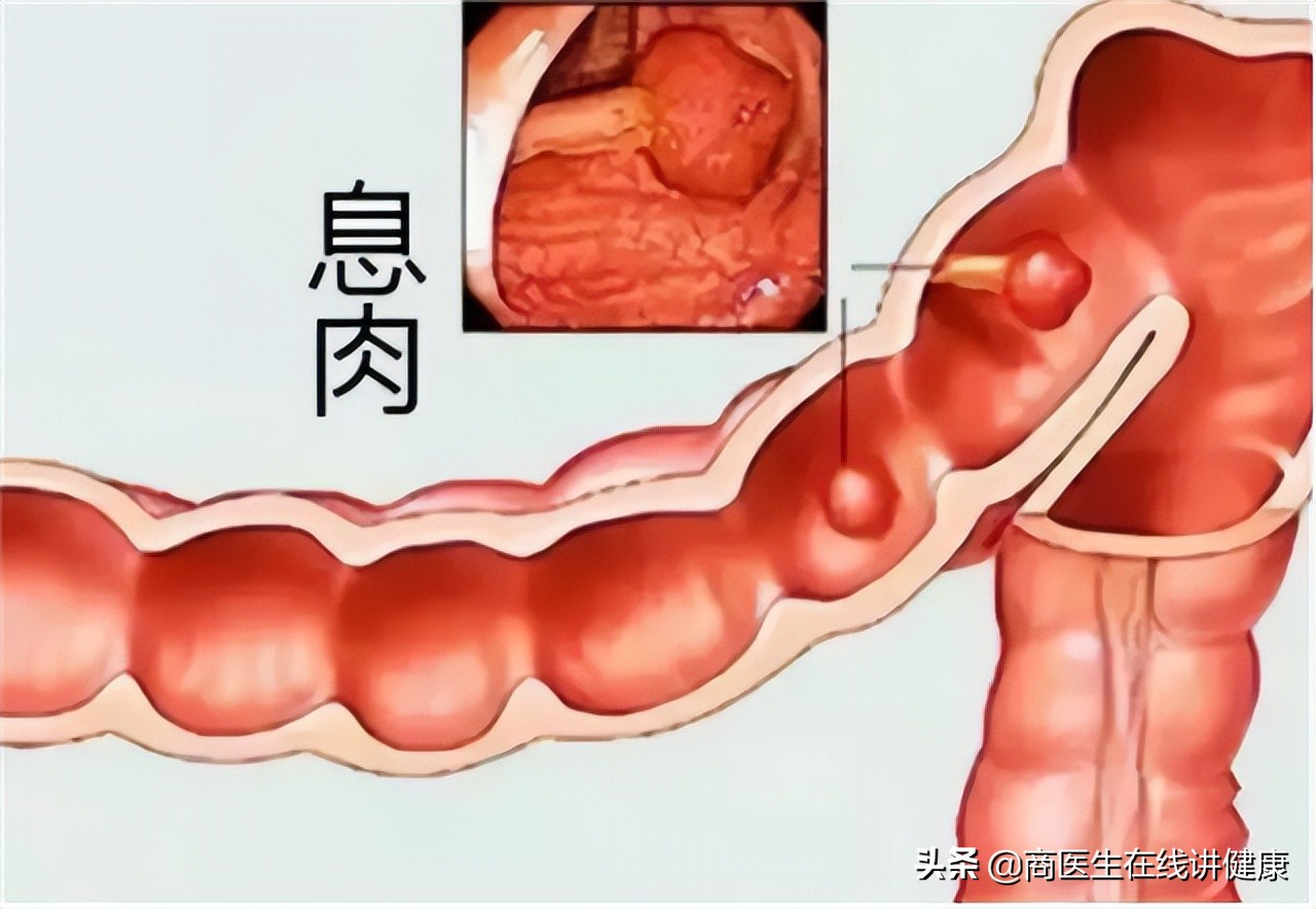 为什么会有肠道息肉,为什么肠道会长息肉