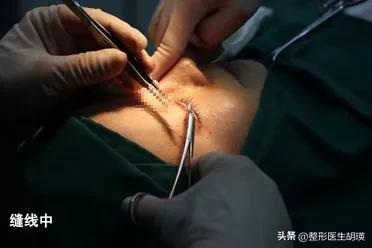 双眼皮术后20天基本不再变化了,挑战双眼皮术后39天做睫毛