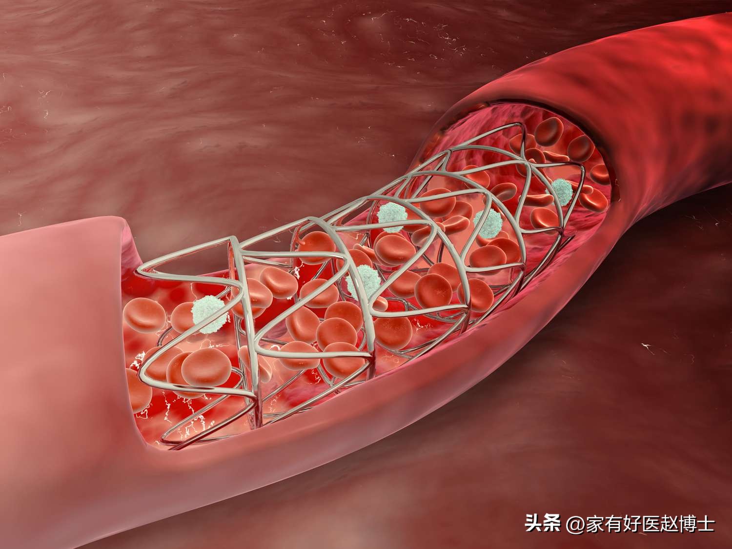 放了心脏支架如果支架坏了咋办,放了心脏支架为什么要抗凝血