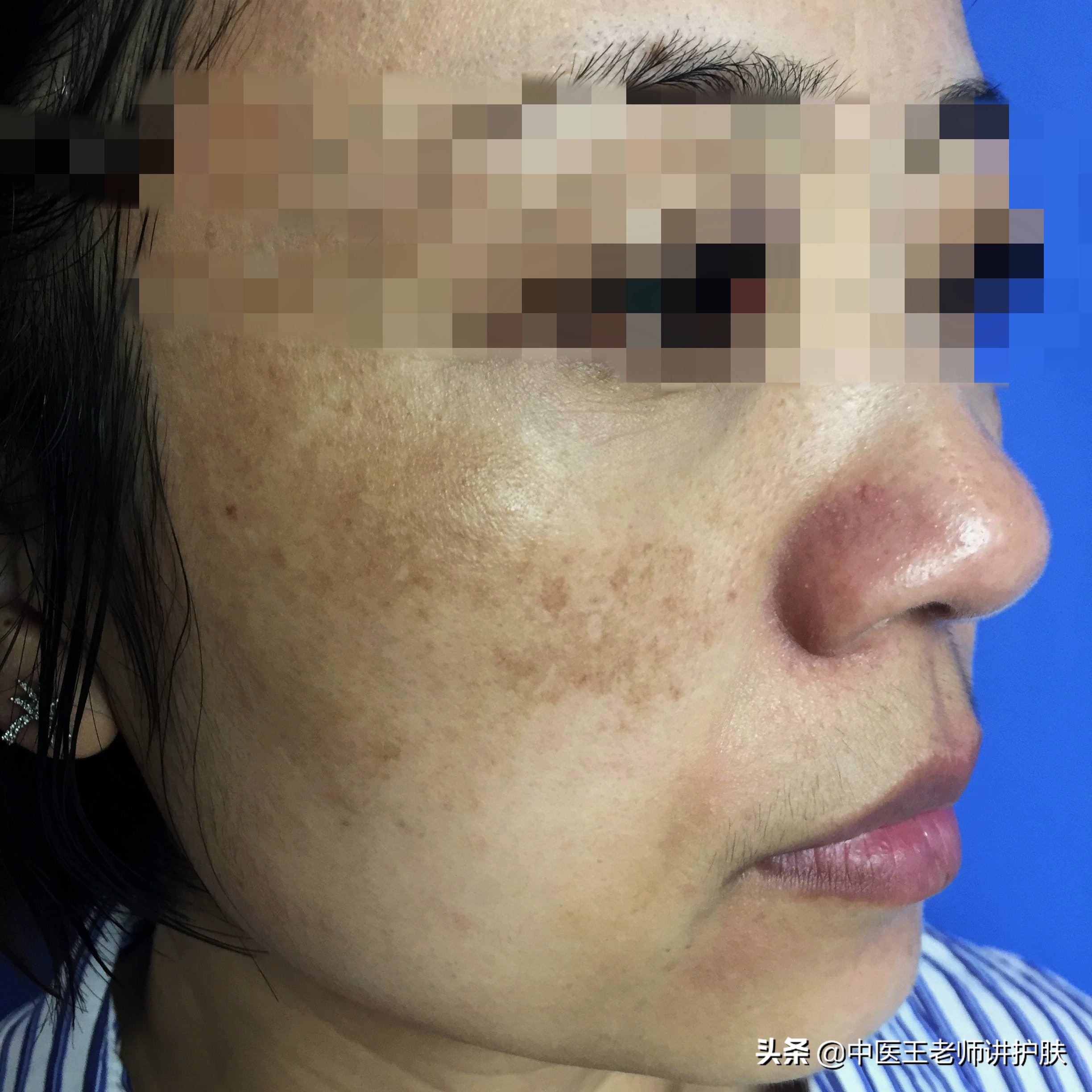 疏肝化瘀调理是治标还是治本,补气血疏肝理气能淡黄褐斑吗