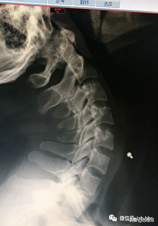 颈椎和脊椎骨质增生怎么治疗更好,颈椎3-7节骨质增生怎么办