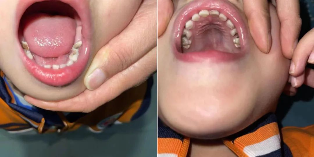 乳牙坏了不疼医生说神经坏了,乳牙坏了不用管