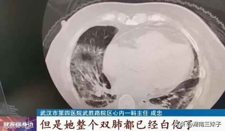 普通严重感冒会成白肺吗,流行感冒白肺